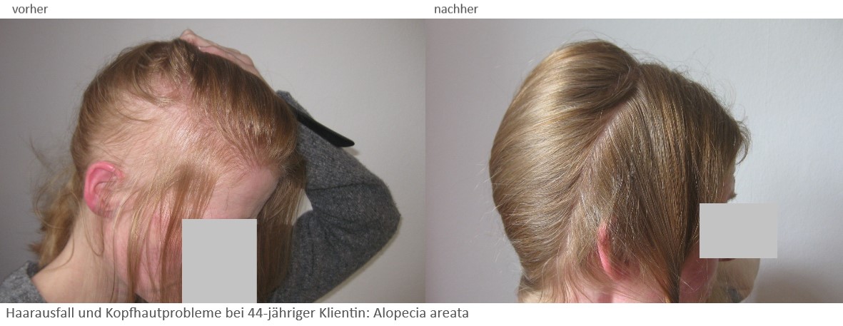 Vorher-Nachher Haarausfall Frau - Category: Galerie Vorher-Nachher