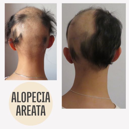 Vorher Nachher Haarausfall Mann Alopecia Areata